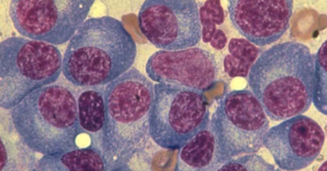  Mieloma Múltiple: Segunto cáncer hematológico más común